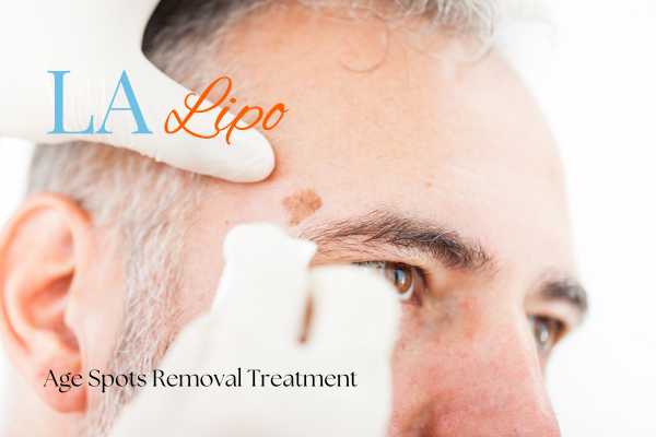 What Are the Most Effective Treatments for Age Spots Willesden Green?