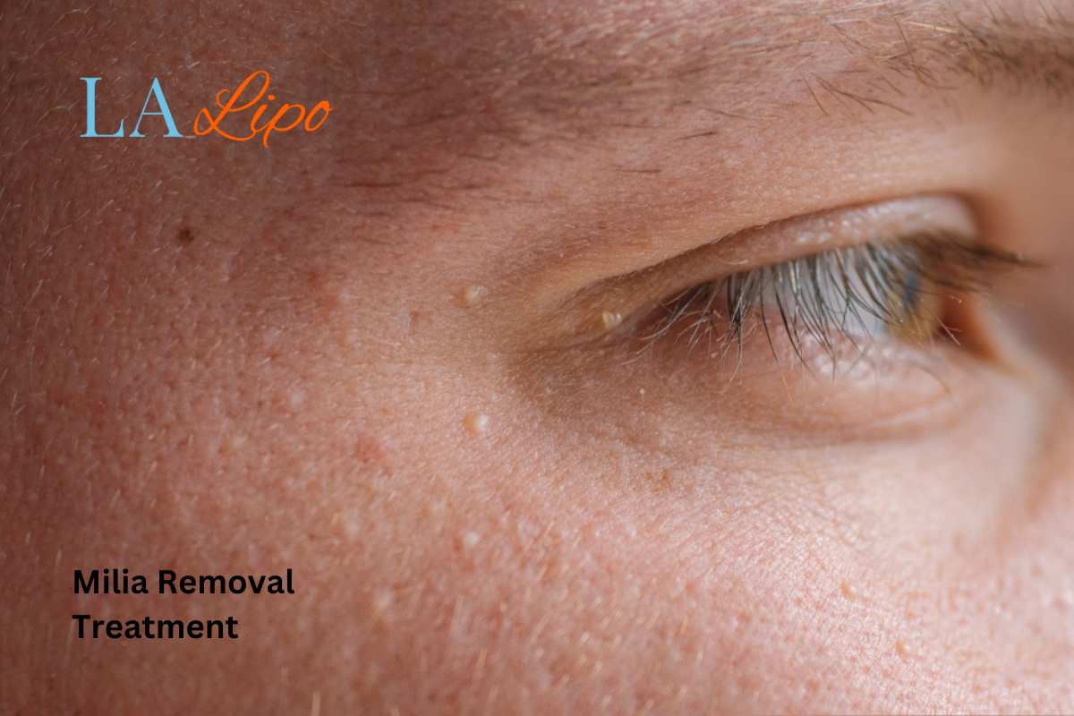 Cryopen Milia Removal: Is It the Easiest and Safest Option Willesden Green?