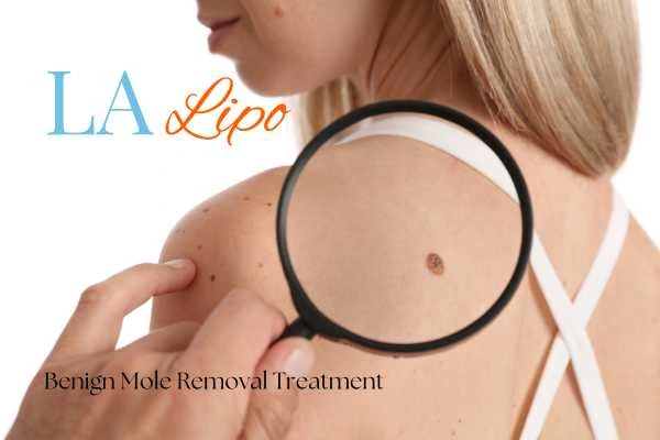 Why getting moles removed Willesden Green can boost your confidence!