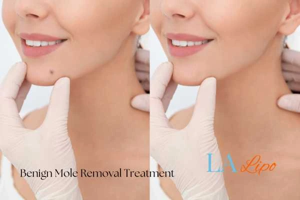 Woman's before and after results of being moles removal treatment Willesden Green