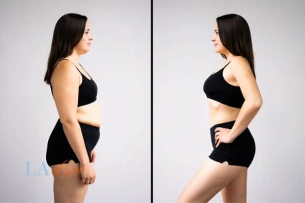 image of woman before and after results of LA-EMS Body Sculpting Willesden Green to help treat Diastasis recti