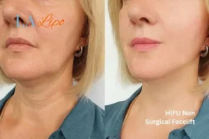 hi-fu for wrinkles Willesden Green before and after results
