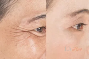 Before and after results of woman - HI-fu wrinkles reduction treatment Willesden Green