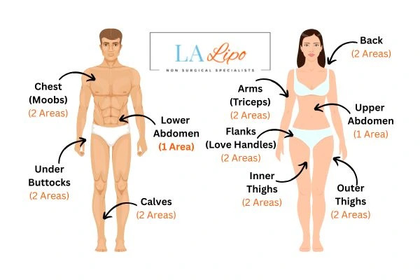 LA LIPO Cryolipolysis Areas Willesden Green