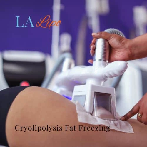 fat freezing - Cryolipolysis Willesden Green