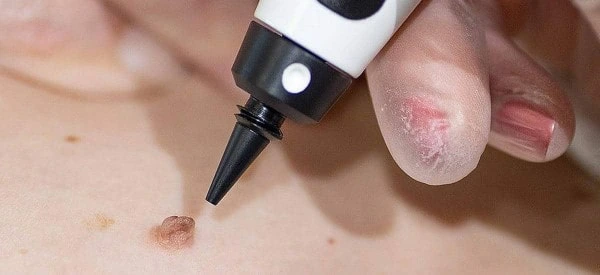 skin tag removal using cryopen Willesden Green