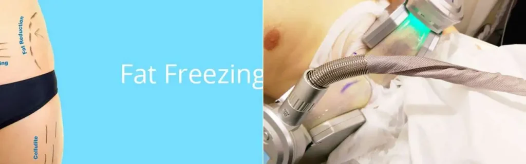 Fat freezing Willesden Green on multiple areas of the body
