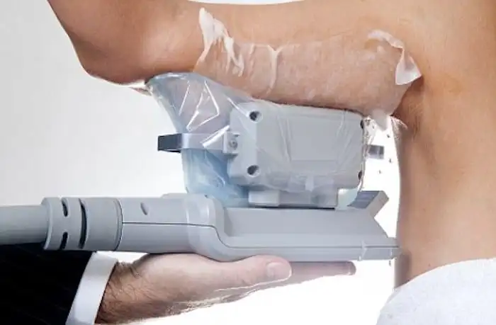Picture of fat freezing Willesden Green on the upper arms.