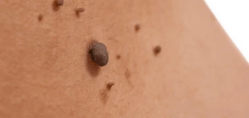 image of a skin tag Willesden Green
