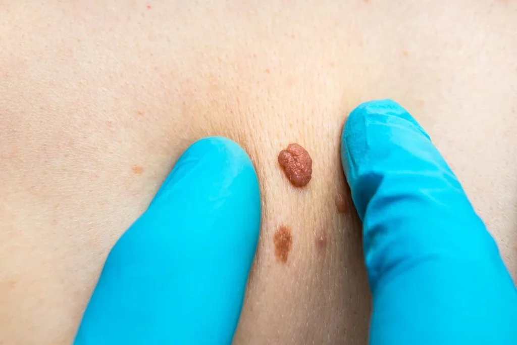 Consultant examining a skin tag Willesden Green