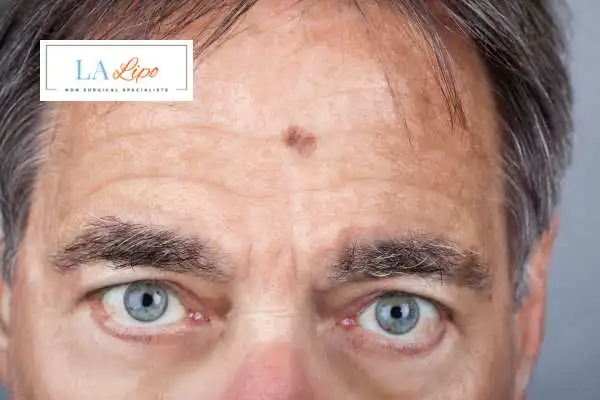Solar Lentigo Removal Willesden Green image of man with mark on his forehead