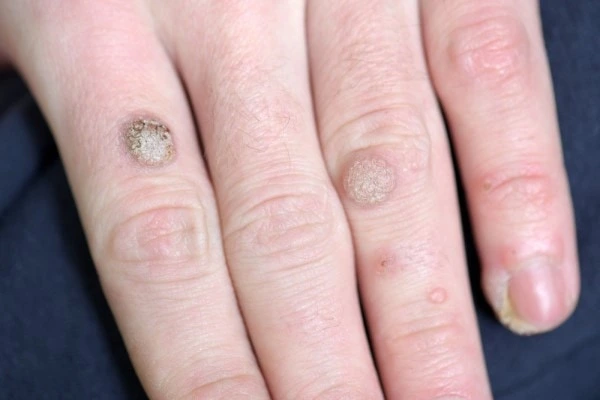photo of warts on person hand - see wart removal Willesden Green from LA LIPO