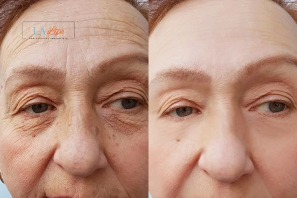 The powerful benefits of Morpheus8 Treatment Willesden Green - Call Our team today!