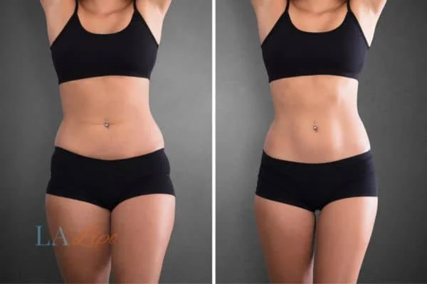 before and after results of non-surgical treatment to help a woman's body image and mental health Willesden Green