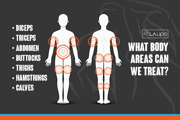 Diagram to show areas you can have LA-EMS Body Sculpting Treatment Willesden Green