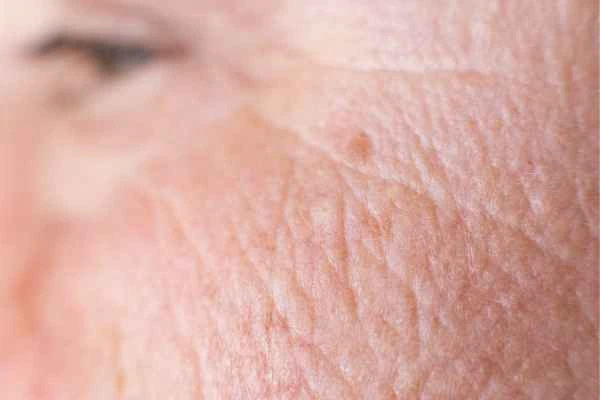 close up picture of a woman's face showing an age spot Willesden Green