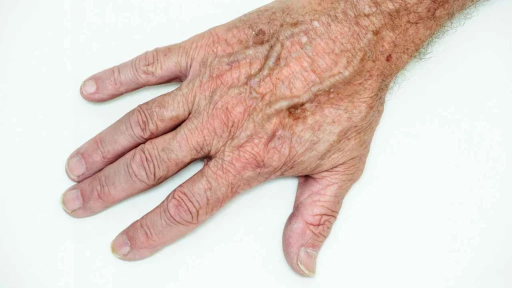 Male hand showing age spot Willesden Green