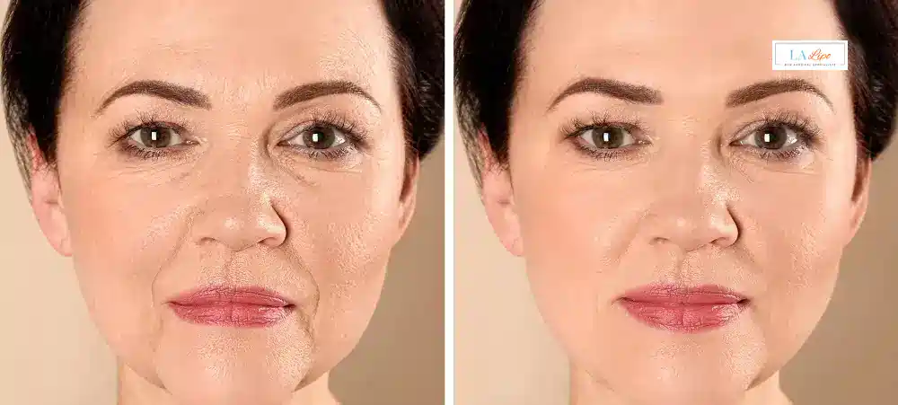 How Long Does It Take to See Results and How Long Do They Last Willesden Green?
